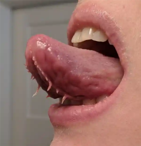 惊现罕见奇观！男子舌下竟藏两条神秘流苏，医学界震惊