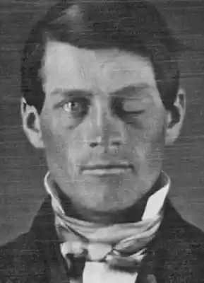 铁棒穿头奇迹生还！男子大脑外溢仍正常生活12年