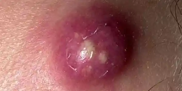 揭秘红包背后的隐秘危机：硬挤真可能致命！