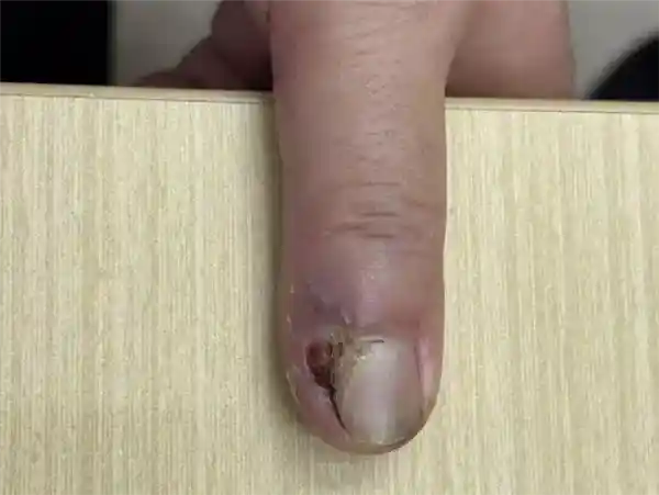 指甲里藏着的隐形杀手：医生切开瞬间惊呼‘癌中之王’现身！
