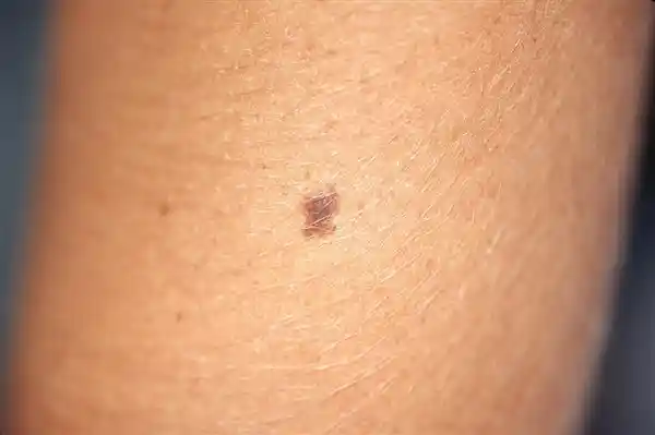 警惕！这5个特征暗示痣可能癌变，别再忽视身体发出的信号