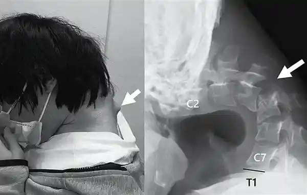 低头族惨烈代价！25岁日本男子颈椎变形如折纸，竟因长期玩手机玩出骨刺？