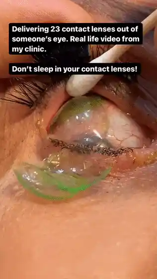 惊爆！女子眼中惊现23个隐形眼镜，层层叠叠宛如神秘‘眼妆’，自己却全然不知！