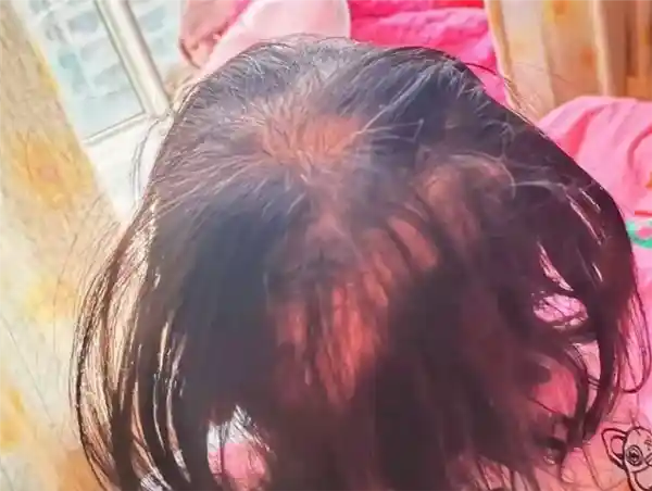 《3岁女童神秘脱发伴铊中毒疑云：眼神呆滞引关注》