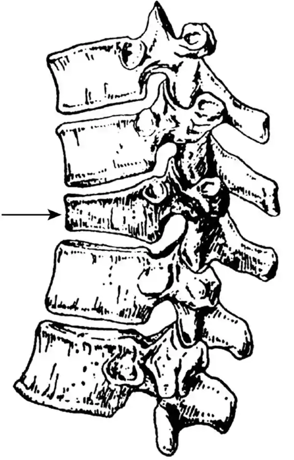 《轻轻一滑竟致腰椎骨折，她的躺平为何如此惊心？》