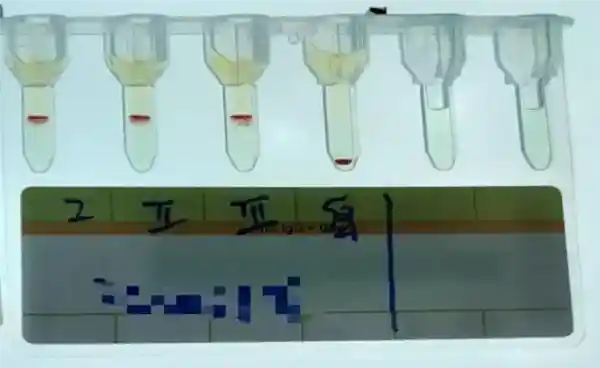 全球罕见！云南发现熊猫血的升级版——小p血型