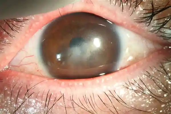 《眼科医生拍桌警告：做这些事，眼睛真的可能废了！》