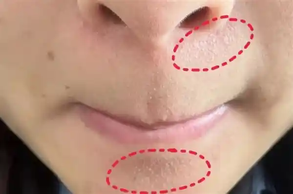 下巴凸起小颗粒？可能是隐形健康警报！